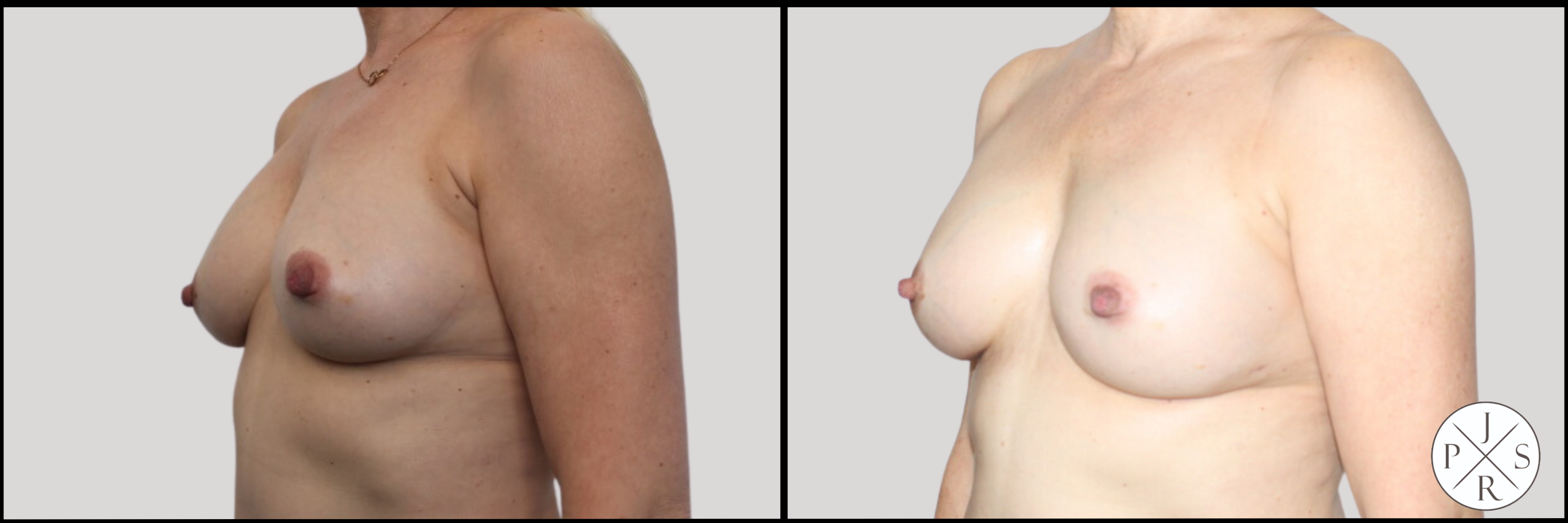 Breast Revision Before & After Image